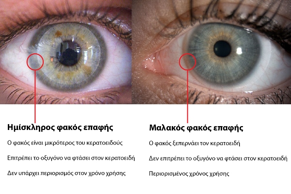 Kontaktlinsen 1